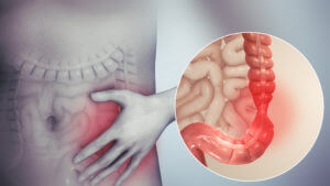 Imagen de un cuerpo trasparente mostrando el colon irritado y con una mano sobre la zona afectada.