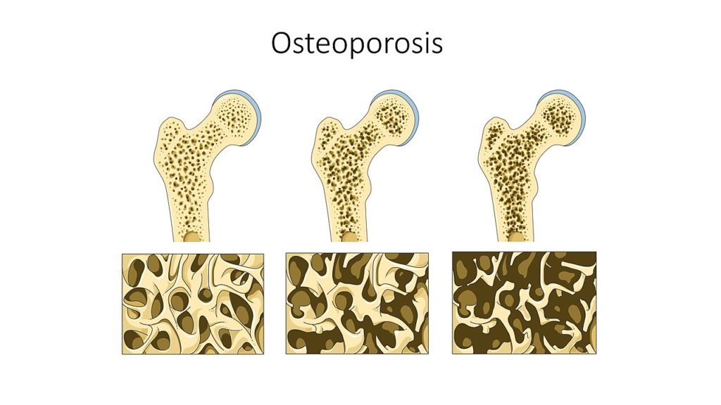 Comparativa de tres huesos que muestran como evoluciona la osteoporosis.