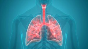 diferencia entre neumonia y pulmonia