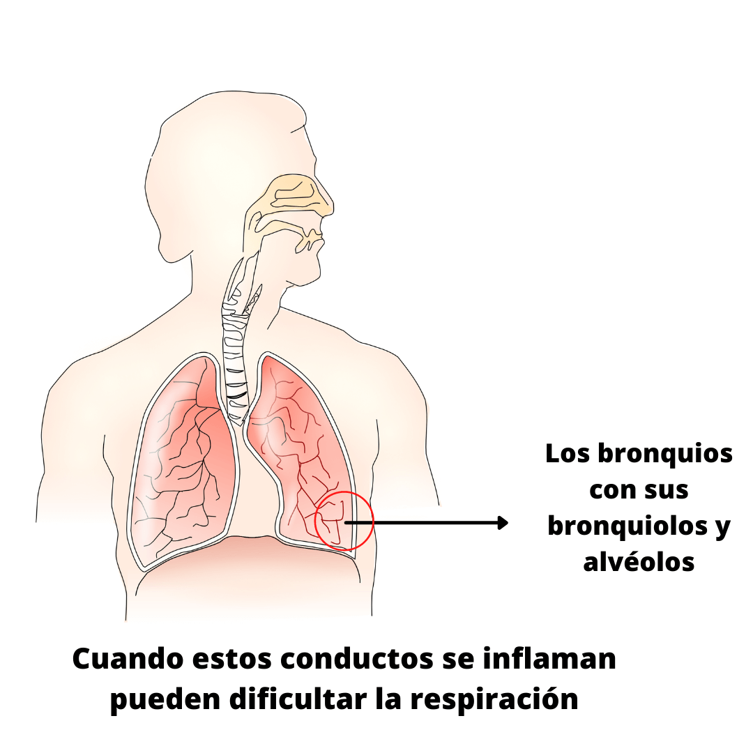 Se muestra un dibujo de los pulmones del ser humano, señalando la posición en la que se encuentran los bronquiolos y alvéolos, que cuando se inflaman puede producir bronconeumonía. 