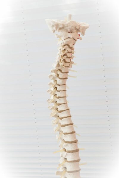 Fotografía de una columna aquejada de una hernia discal.