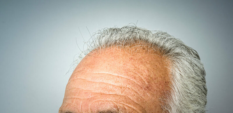 Un plano detalle de la frente y la cabeza con alopecia de un anciano.