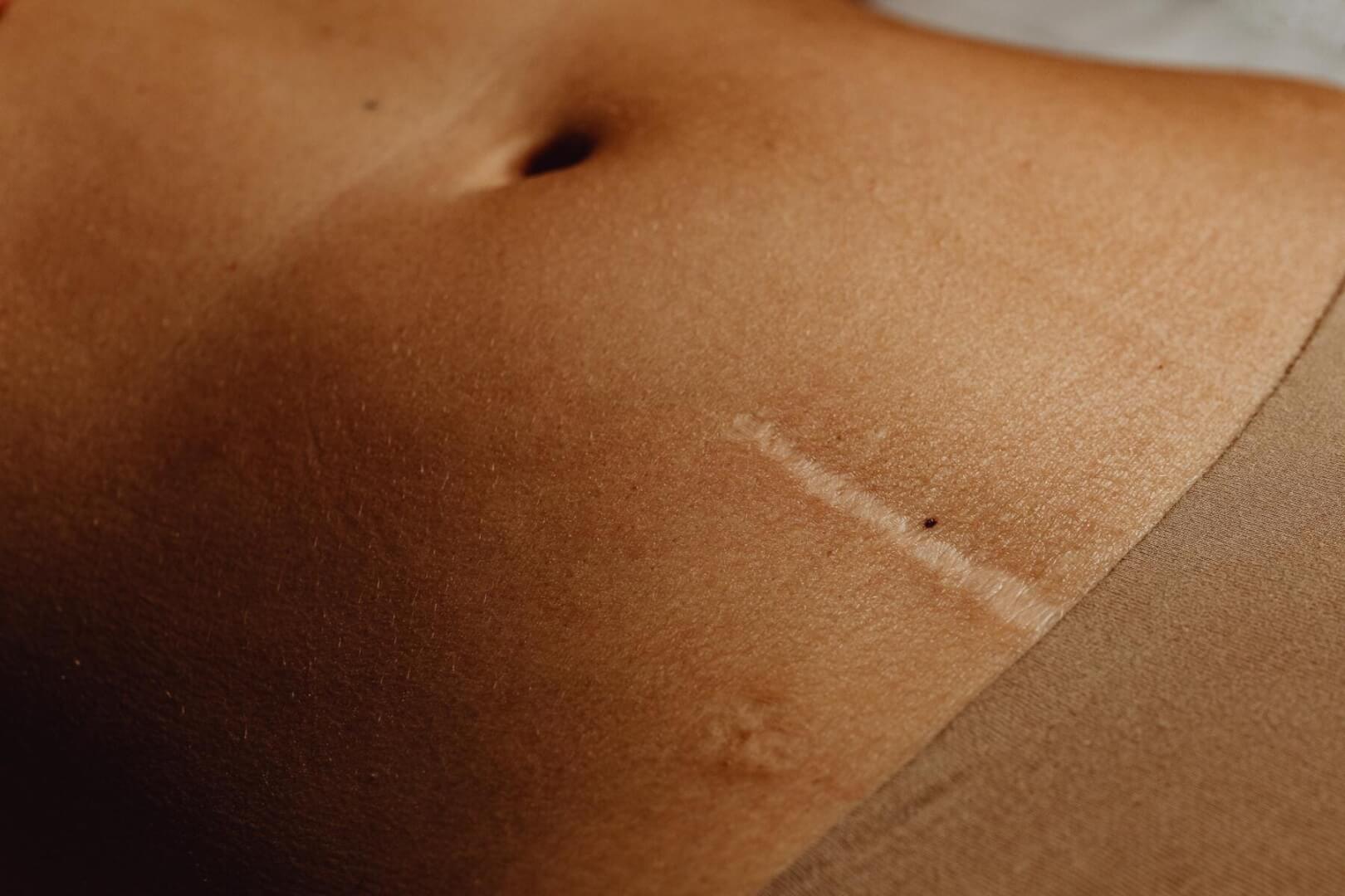Foto de una mujer con cicatriz en la zona abdominal