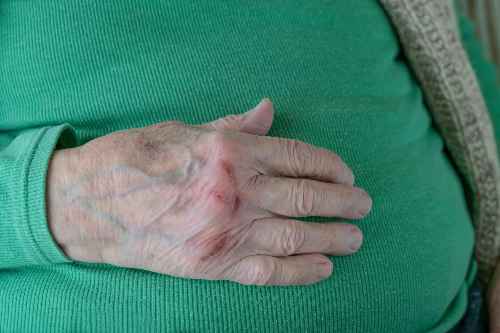 Un plano corto de una mano de un anciano con una cicatriz.