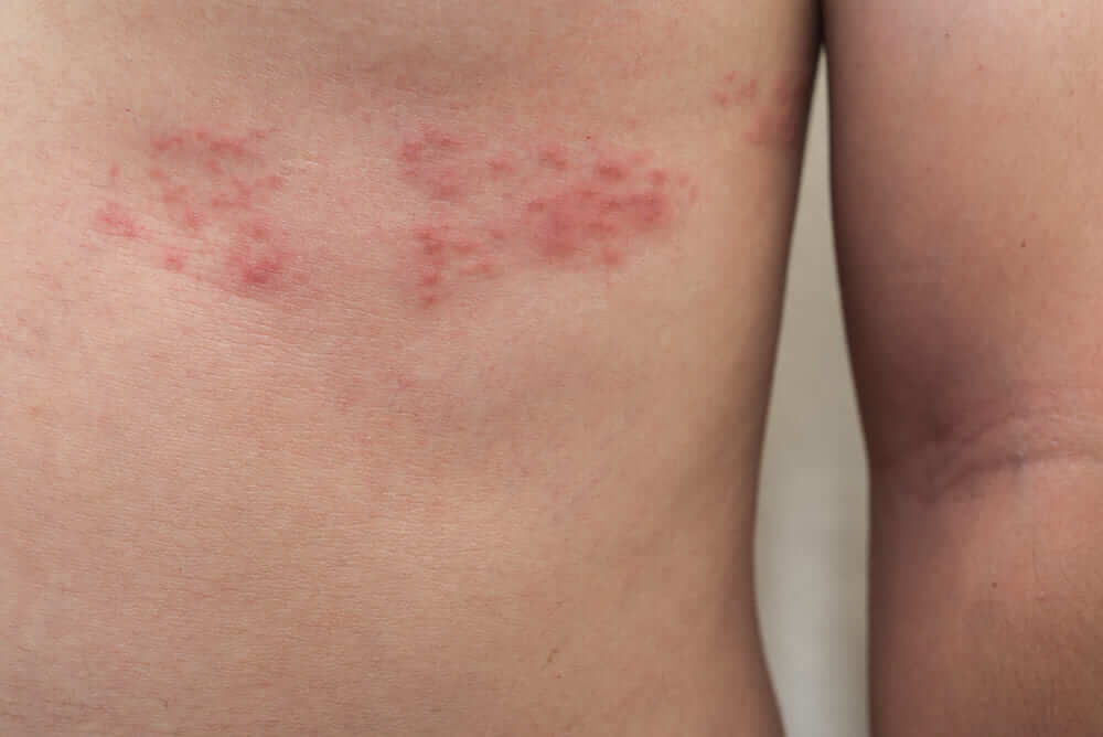 Una imagen en plano corto de un costado de una persona con la piel irritada como consecuencia del herpes zóster. 