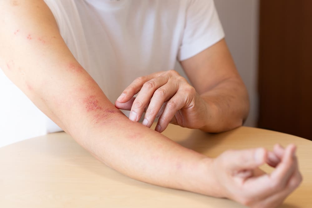 Una persona con herpes zóster se toca la piel del brazo para cuidarla por la infección. 