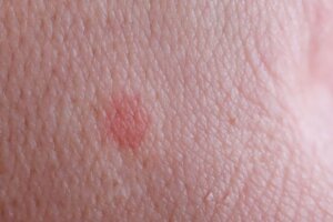 Una picadura de pulga en la piel que provoca una rojez.