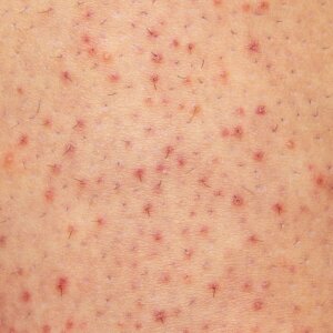 Un plano de la piel de una persona con granos rojos, que es foliculitis.