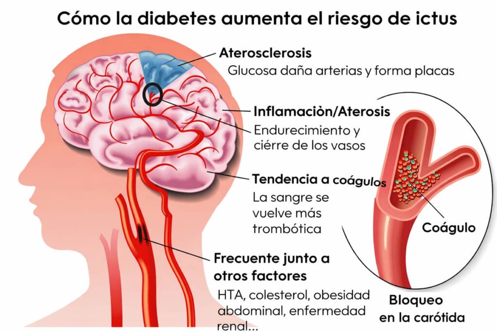 como diabetes aumenta riesgo ictus