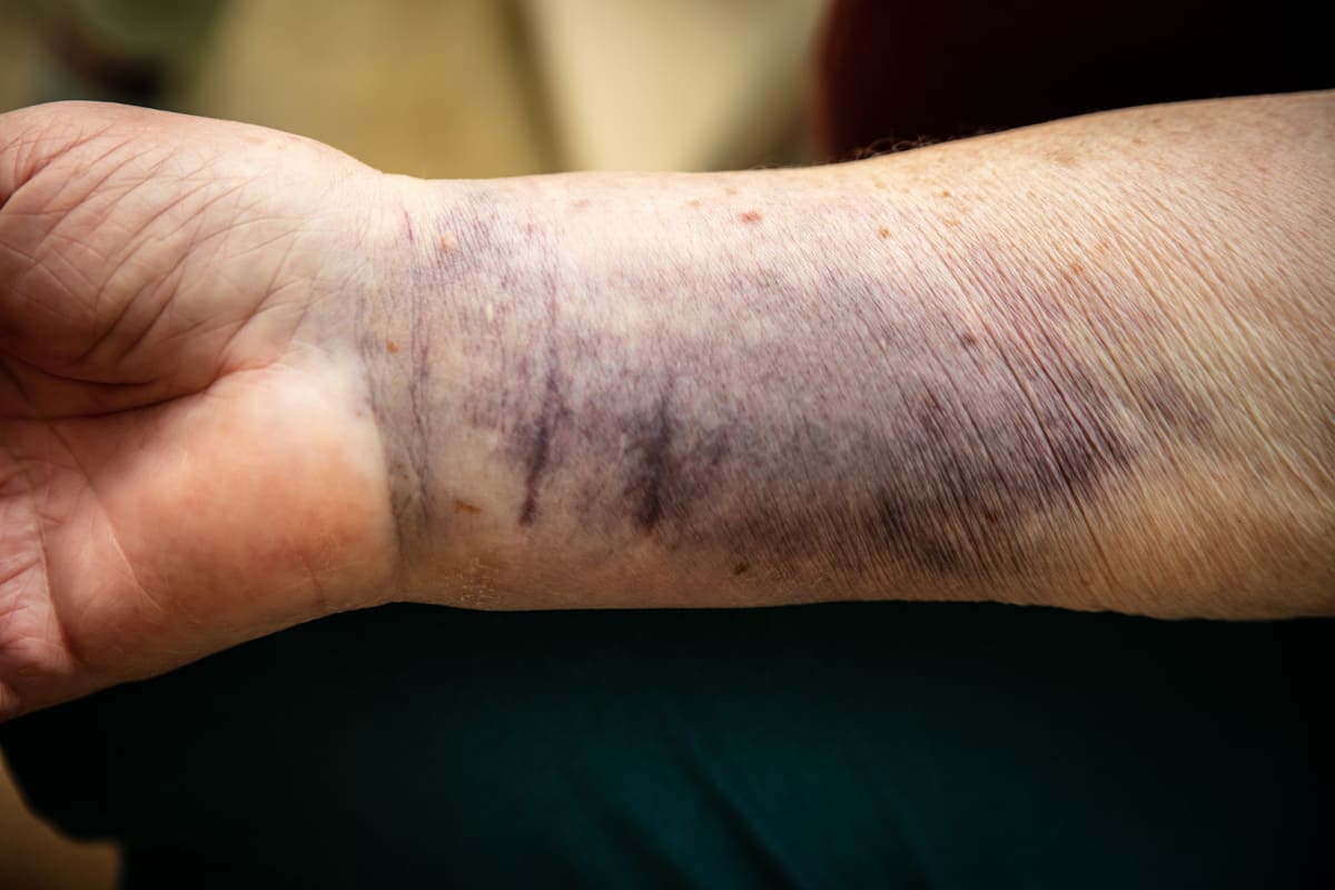 Señales de que tu padre o madre no puede vivir solo Moraton por golpe en el brazo de una persona anciana