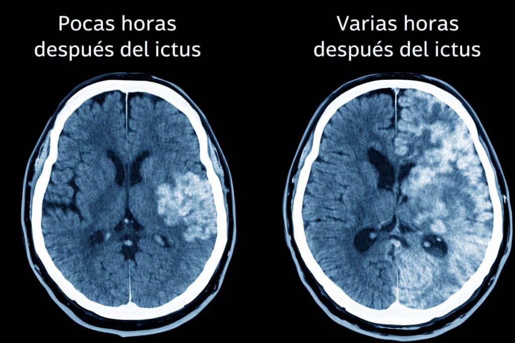 cerebro antes después ictus